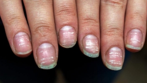 T?rnak lekesi deyip hafife almay?n! T?rnak lekesinin alt?nda çok önemli hastal?klar?n belirtileri olabilir...