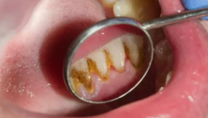 Di? tartar?n? ve ta?lar?n? temizlemenin en etkili yolu